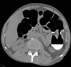 Colon Cancer - CTisus CT Scan