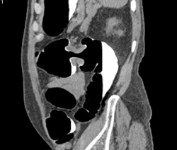 Colon Cancer - CTisus CT Scan