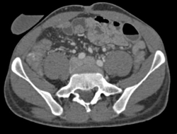 Osteomy - CTisus CT Scan