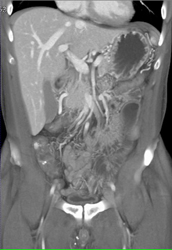 Appendicitis - CTisus CT Scan