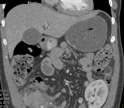 Acute Pancreatitis in Pancreatic Tx and Acute Pyelonephritis in Renal Tx - CTisus CT Scan