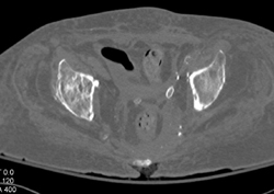 Radiation Induced Ulcer - CTisus CT Scan