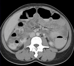 Pseudomembranous Colitis (PMC) - CTisus CT Scan