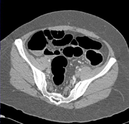 Endometriosis Descending Colon - CTisus CT Scan