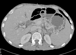 Neurofibromatosis - CTisus CT Scan