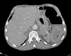 Splenic Flexure Cancer - CTisus CT Scan