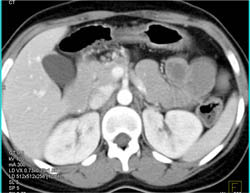 Ulcerative Colitis - CTisus CT Scan