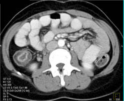 Ulcerative Colitis - CTisus CT Scan