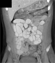 Ulcerative Colitis - CTisus CT Scan