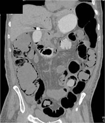 Pneumatosis Coli With Portal Vein Gas Due to Ischemic Bowel - CTisus CT Scan