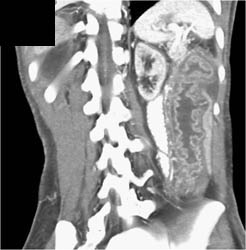 Pseudomembranous Colitis (PMC) - CTisus CT Scan