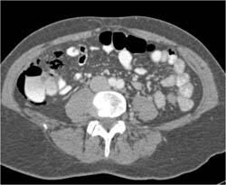 Pneumatosis in Cecum - CTisus CT Scan