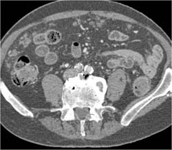 Omental Implants - CTisus CT Scan