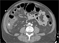 Gastrointestinal (GI) Bleed in Cecum Simulated By A Pill - CTisus CT Scan