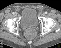 Acute Bleed in Rectum - CTisus CT Scan