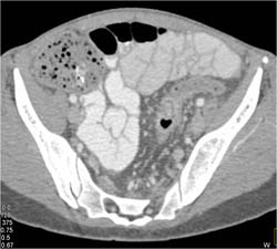 Perirectal Abscess in Crohn's Disease - CTisus CT Scan