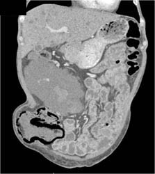 Extensive Pneumatosis S/P Renal Transplant - CTisus CT Scan