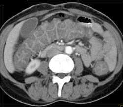 Pseudomembranous Colitis (PMC) - CTisus CT Scan