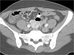 Appendicitis - CTisus CT Scan