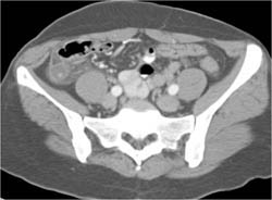 Appendicitis - CTisus CT Scan