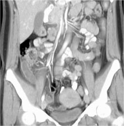 Appendicitis - CTisus CT Scan