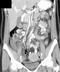 Appendicitis - CTisus CT Scan