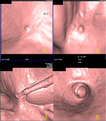 Colon Polyp - CTisus CT Scan