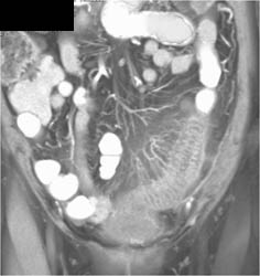 Ischemic Colitis - CTisus CT Scan