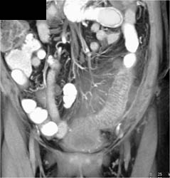 Ischemic Colitis - CTisus CT Scan