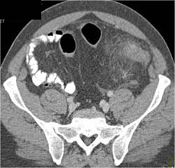 Diverticulitis - CTisus CT Scan