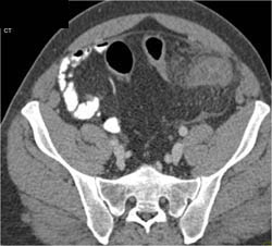 Diverticulitis - CTisus CT Scan