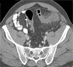 Diverticulitis - CTisus CT Scan