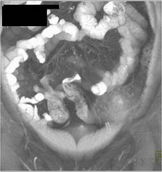 Diverticulitis - CTisus CT Scan