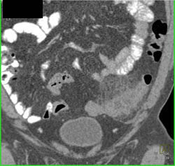 Diverticulitis - CTisus CT Scan