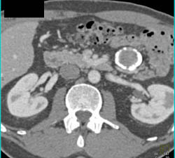 Calcified Mesenteric Cyst - CTisus CT Scan