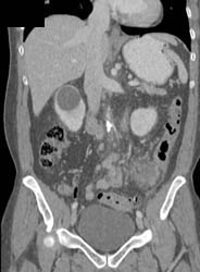 Diverticulitis- Descending Colon - CTisus CT Scan