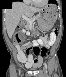 Pseudomembranous Colitis (PMC) - CTisus CT Scan