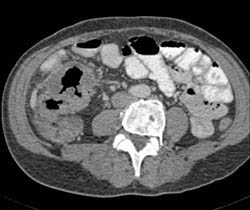 Pseudomembranous Colitis (PMC) - CTisus CT Scan