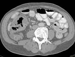 Pseudomembranous Colitis (PMC) - CTisus CT Scan