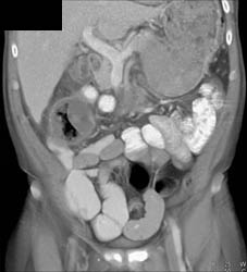 Pseudomembranous Colitis (PMC) - CTisus CT Scan