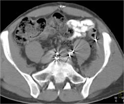 GSW to Pelvis Near Colon - CTisus CT Scan