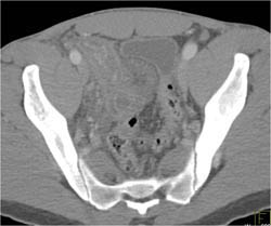 Appendicitis - CTisus CT Scan