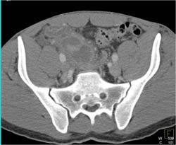 Appendicitis - CTisus CT Scan