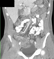 Appendicitis - CTisus CT Scan