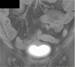 Fistulae From Colon to Bladder - CTisus CT Scan