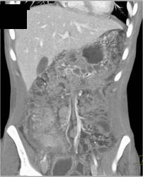 Pseudomembranous Colitis (PMC) - CTisus CT Scan