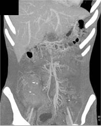 Pseudomembranous Colitis (PMC) - CTisus CT Scan