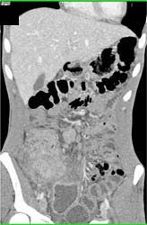 Pseudomembranous Colitis (PMC) - CTisus CT Scan