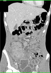 Pseudomembranous Colitis (PMC) - CTisus CT Scan