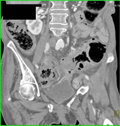 Pseudomembranous Colitis (PMC) - CTisus CT Scan